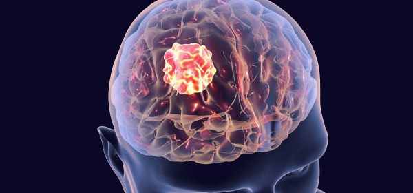 چگونه یک جراح متخصص مغز و اعصاب تومورها را درمان می‌کند؟